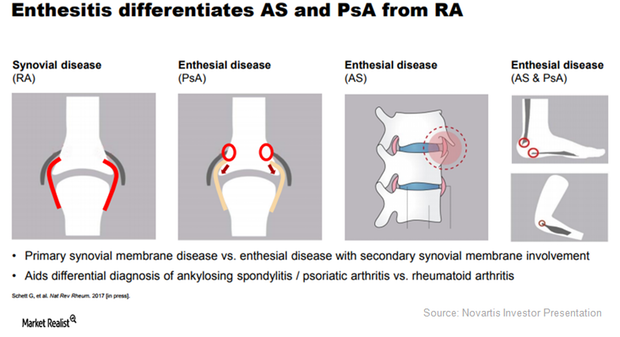 How Cosentyx Resolves Enthesitis in Psoriatic Arthritis