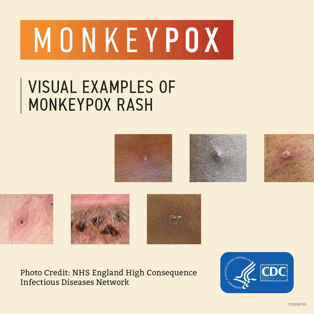 monkeypox symptoms