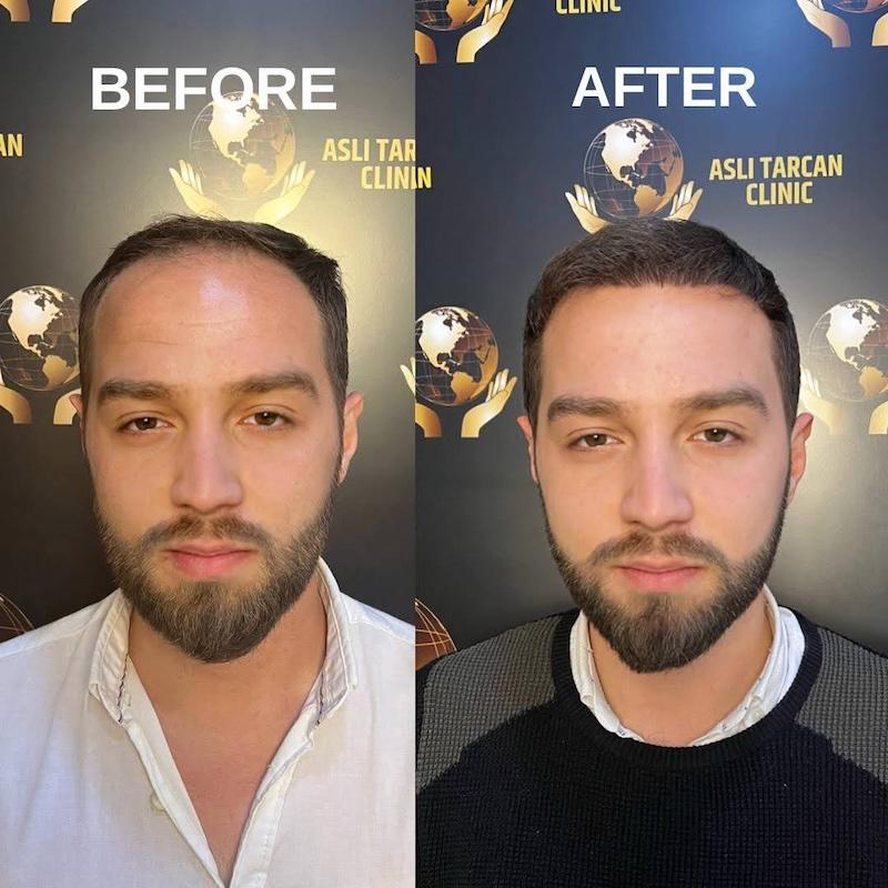 hair transplant before after