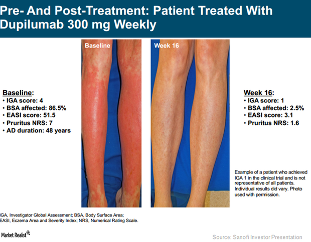 Dupixent Leading Therapy For Atopic Dermatitis In The Future 3819