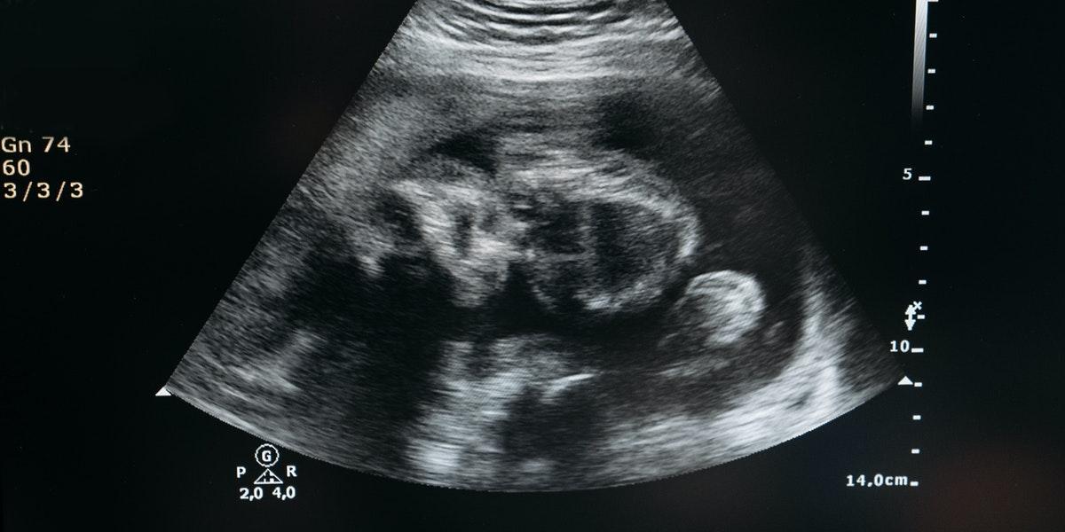 An ultrasound