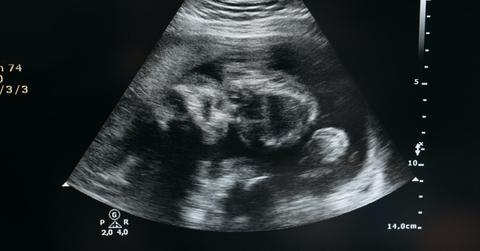 An ultrasound
