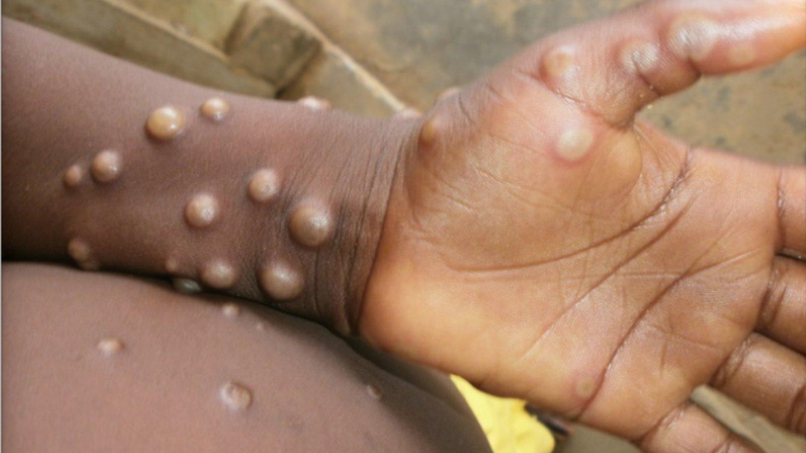 A person with monkeypox sores on their hand and arm