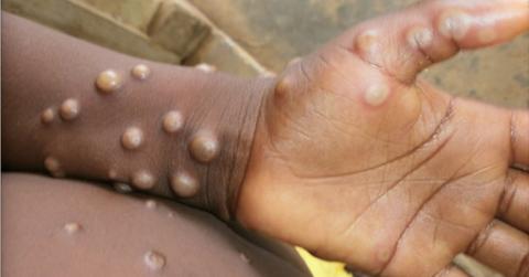 A person with monkeypox sores on their hand and arm
